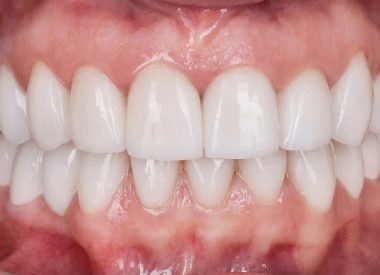 Пациентке было предложено изменить высоту зубов, форму и цвет при помощи керамических реставраций, также на нижней челюсти мы предложили изменить форму правого клыка на боковой резец и из отсутствующего 4-го зуба сделать клык.