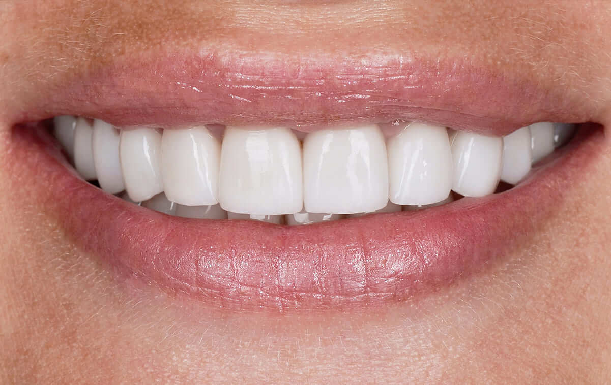 Replacement of old composite restorations with ceramic crowns