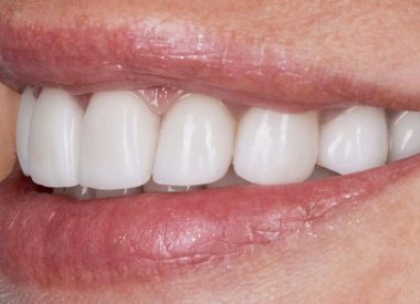 Within a month, ceramic restorations were made and fixed on both jaws.