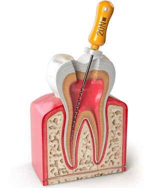 root canal cleaning