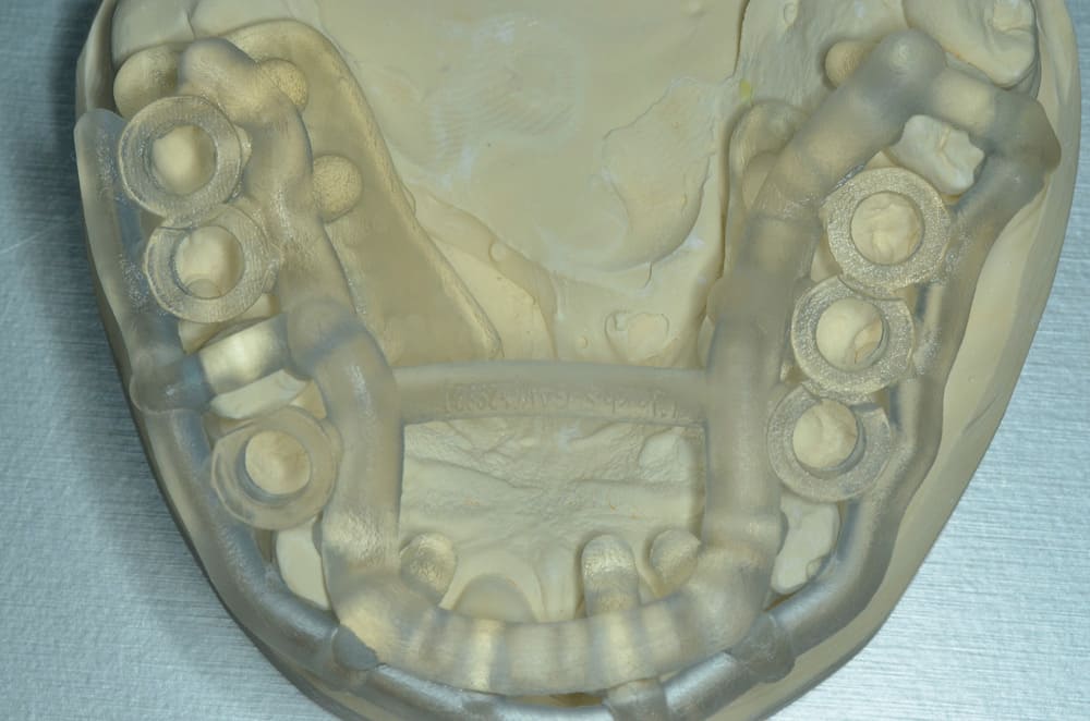 Surgical templates, produced digitally