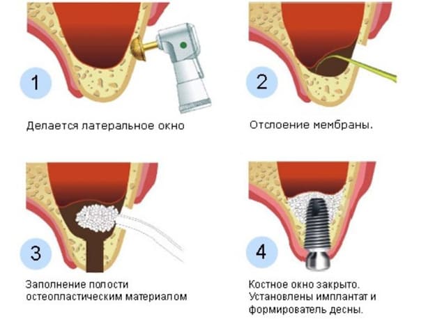 Этапы проведения синус-лифтинга