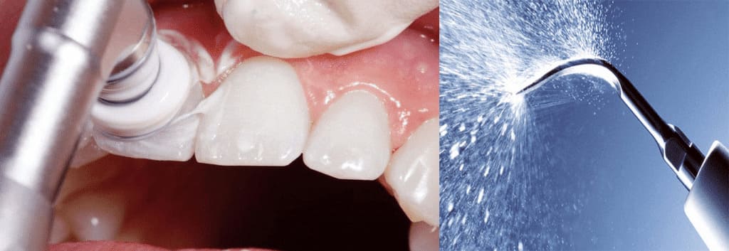 Removal of braces and retainers placement