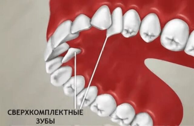Сверхкомплектные зубы