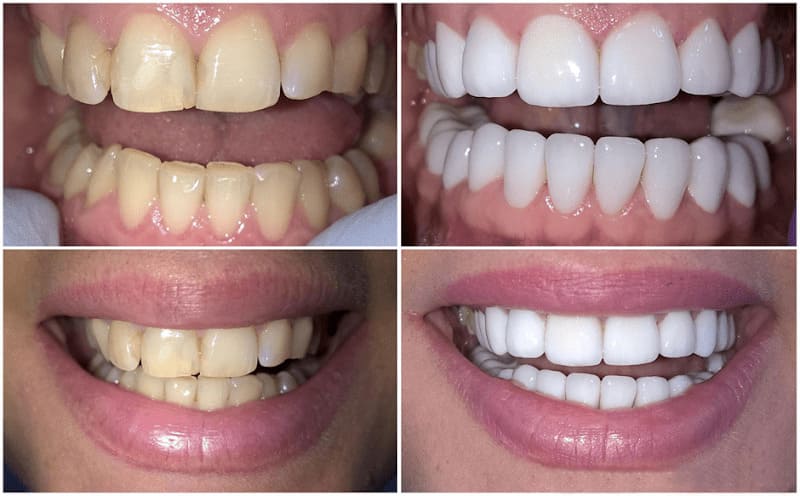 The Neglected Teeth Treatment