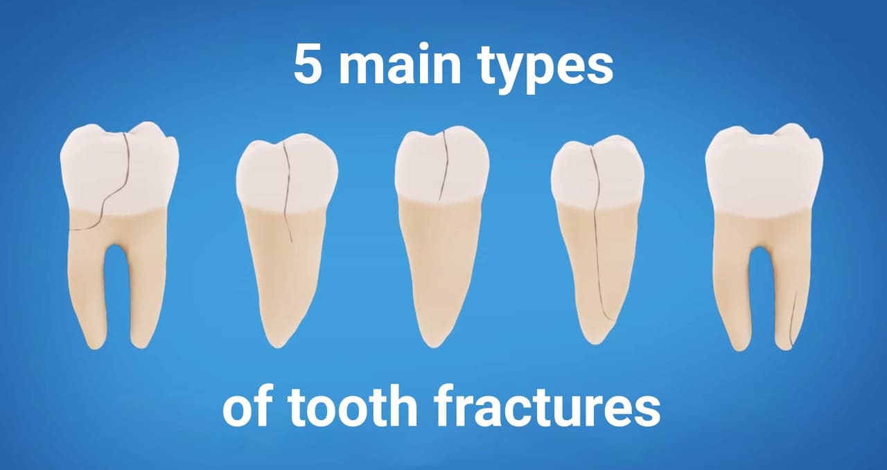 tooth fractures