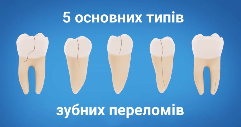 Зубні переломи