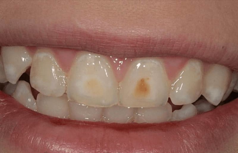 Пігментні плями на зубах