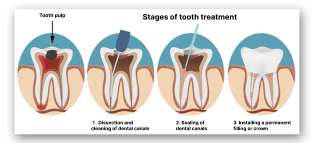 The Neglected Teeth Treatment What to Start with