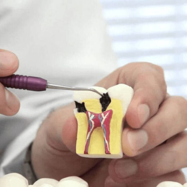 Forms of dental pulpitis