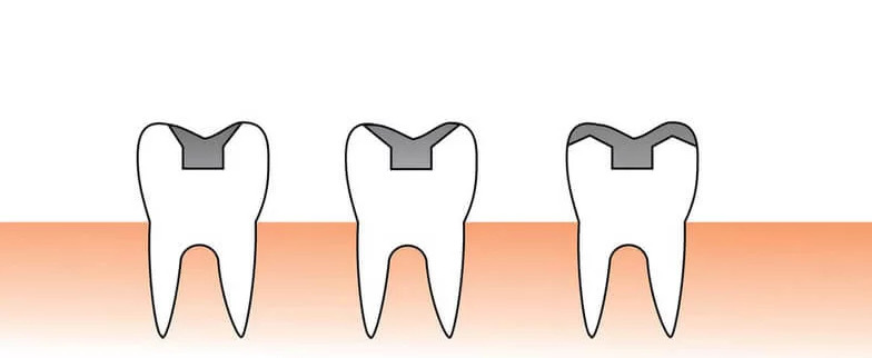 Inlay-Retained Prosthesis Advantages and Disadvantages Photo 614