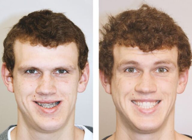 Photo of a person during brace treatment and after brace removal