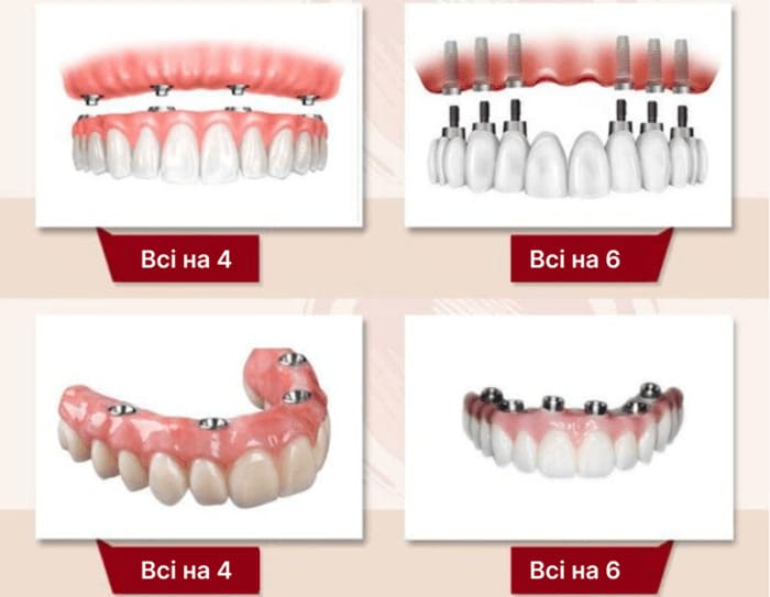 Способи реконструкції зубів