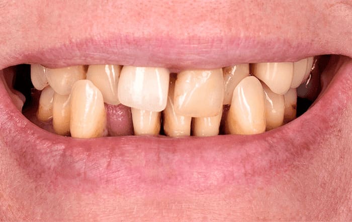 Які матеріали використовують для ушивання рани на яснах