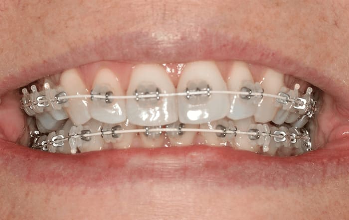 Why is it important to take proper care of braces?