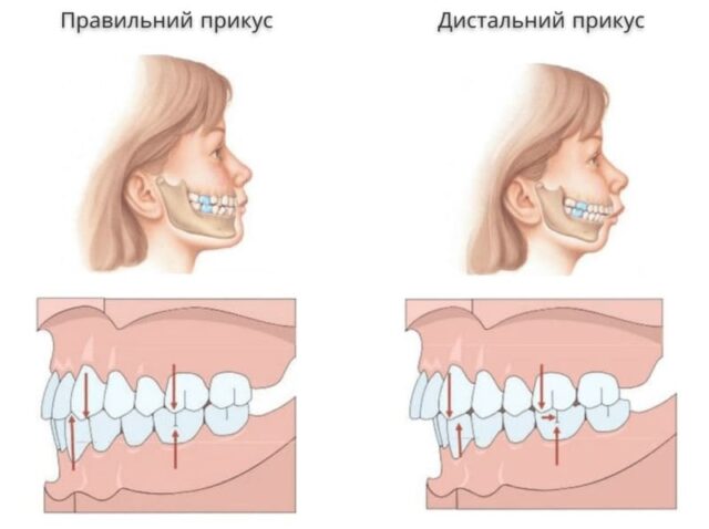 Як брекети змінюють обличчя?