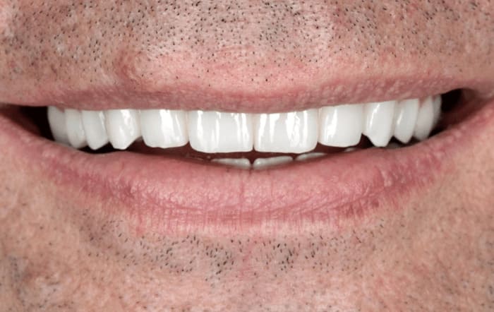 Восстановление зубов коронками на имплантах