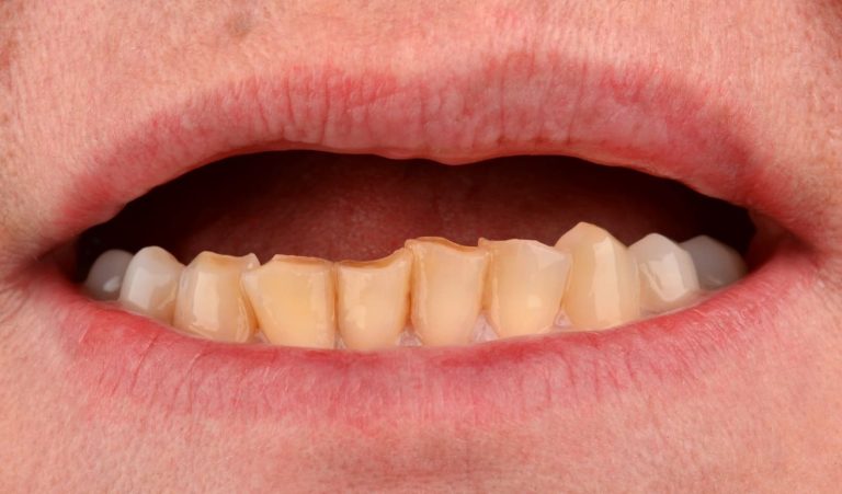 Orthopedic rehabilitation of а Patient with a zirconium structure supported by implants, performed in the shortest possible time