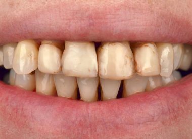It was not an easy case, where we encountered psychological problems related to the Patient’s lack of confidence in implant treatment, fear of tooth extraction, and the risk of being “left with nothing.” Most of the teeth were mobile; there were abscesses in the projection of several teeth and pus flowing from periodontal pockets. The...
