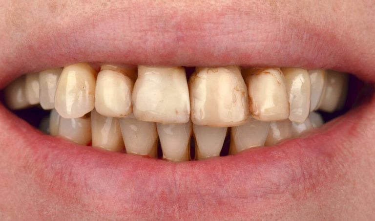 It was not an easy case, where we encountered psychological problems related to the Patient’s lack of confidence in implant treatment, fear of tooth extraction, and the risk of being “left with nothing.” Most of the teeth were mobile; there were abscesses in the projection of several teeth and pus flowing from periodontal pockets. The...