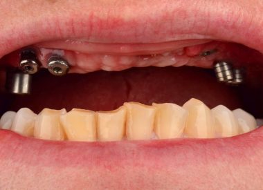 На верхній щелепі зуби були відсутні й раніше. В іншій країні було встановлено 8 імплантатів MIS (Ізраїль). Пацієнтка була у Києві проїздом і у нас було лише 5 робочих днів на виготовлення постійної ортопедичної конструкції.