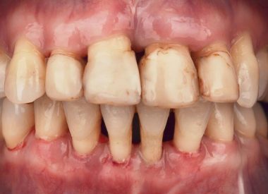 Реабилитация началась с комплексного пародонтологического лечения: инструментальной обработки зубов, профессиональной гигиены, удаления части зубов, местной и общей антибактериальной терапии.
