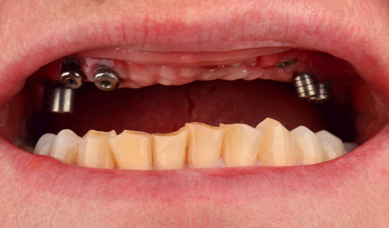 На верхней челюсти зубы отсутствовали  и ранее. В другой стране были установлены 8 имплантатов MIS (Израиль). Пациентка была в Киеве проездом и у нас было всего 5 рабочих дней на изготовление постоянной ортопедической конструкции.
