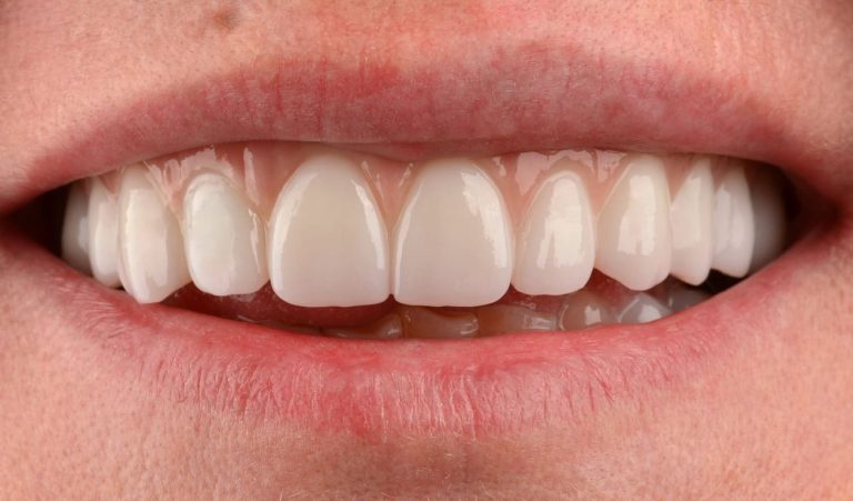 Orthopedic rehabilitation of а Patient with a zirconium structure supported by implants, performed in the shortest possible time