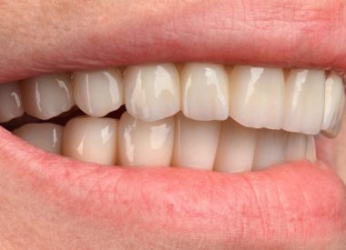 Результат лечения – хороший функциональный и эстетический результат, стабилизация пародонтита вокруг оставшихся зубов и оправданные надежды нашей Пациентки.