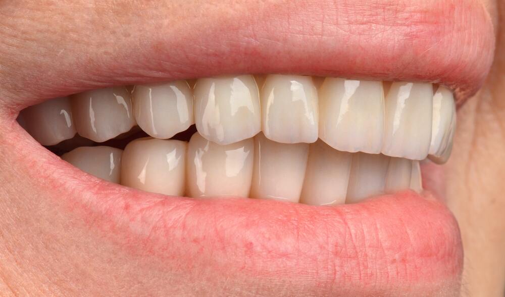 Результат лечения - хороший функциональный и эстетический результат, стабилизация пародонтита вокруг оставшихся зубов и оправданные надежды нашей Пациентки.
