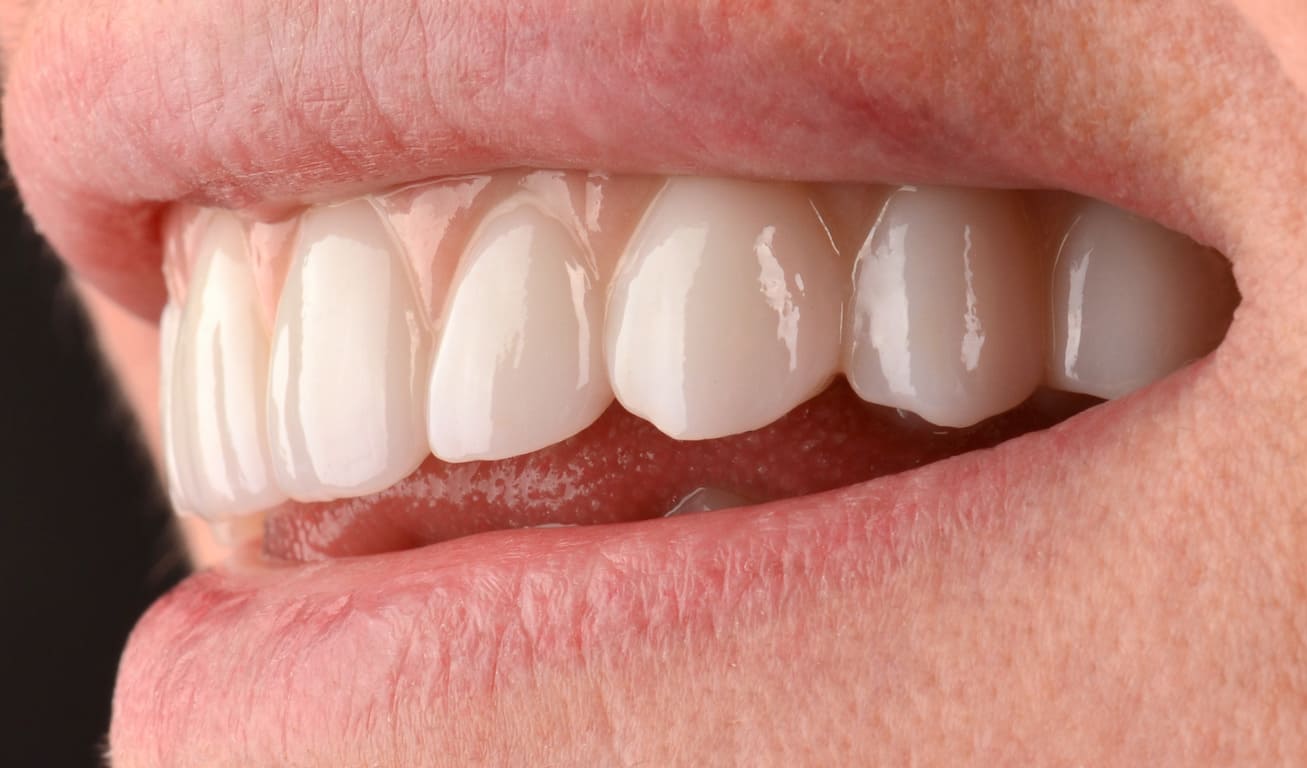The zirconium crowns were fixed to the implants on the upper jaw after five working days.