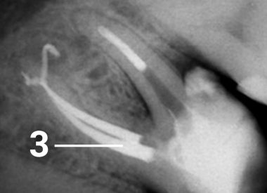 Эндодонтическое лечение проводилось под 20-ти кратным увеличением с помощью дентального микроскопа. 3 – фрагмент извлечен, каналы зуба полностью пройдены и запломбированы.
