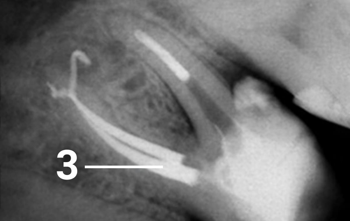 Root canal treatment of a tooth with extraction of an instrument fragment