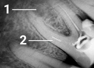 Пациент из другой клиники, где была произведена попытка эндодонтического лечения 36 зуба, обратился с болью в зубе. Выяснилось, что в медиальном канале был сломан эндодонтический инструмент (каналонаполнитель), что стало препятствием для полноценной пломбировки корневого канала. Спустя несколько лет развился периодонтит. 1 – разрушение костной ткани в результате неполного прохождения канала 2 – спиралевидный фрагмент внутриканального...