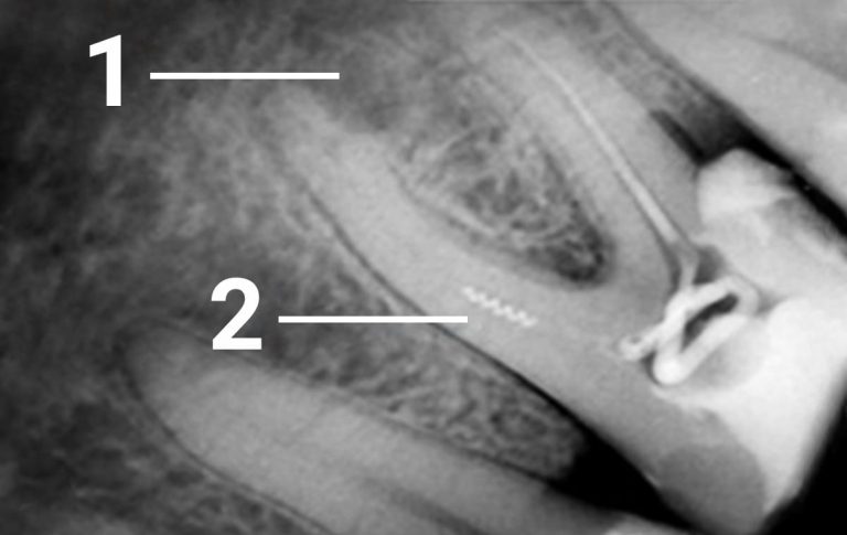 Patient of another clinic where he underwent endodontic treatment of tooth 36 came with pain complaint in this tooth. The reason a broken endodontic instrument (root canal filler) got stuck in the medial canal which hampered properly filling the root canal. Some years later, it led to periodontitis. 1- destruction of the bone tissue due...