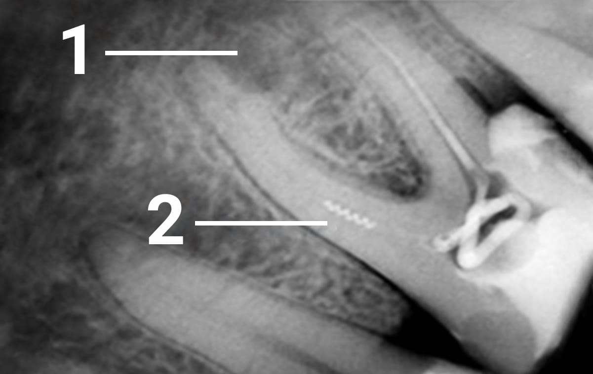 Пациент из другой клиники, где была произведена попытка эндодонтического лечения 36 зуба, обратился с болью в зубе. Выяснилось, что в медиальном канале был сломан эндодонтический инструмент (каналонаполнитель), что стало препятствием для полноценной пломбировки корневого канала. Спустя несколько лет развился периодонтит. 

1 - разрушение костной ткани в результате неполного прохождения канала

2 - спиралевидный фрагмент внутриканального инструмента