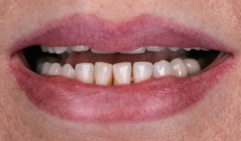 Tooth Extraction with Extensive Caries under Fused Porcelain Crown Reconstruction of both jaws with zirconium implant-supported restoration