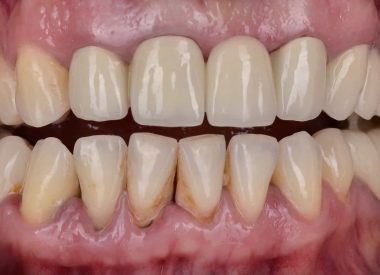 Після огляду та рентгенологічного обстеження з'ясувалось, що більшість зубів під коронками були зруйновані та підлягають видаленню.