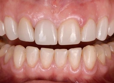 She asked to change the gingival smile line (a high smile line, when a smile exposes a lot of gum tissue) and to lower it with minor cosmetic surgery), to change the shape of the teeth, to expand the dental arch of both jaws and to make the color of the teeth much lighter.