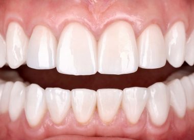 In a short time, we performed soft-tissue correction to change the gingival smile line, prepared teeth for ceramic veneers and crowns, took impressions, and made temporary restorations.
