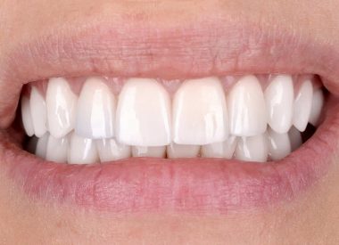 Eight days later, the permanent ceramic veneers/crowns were fixed.