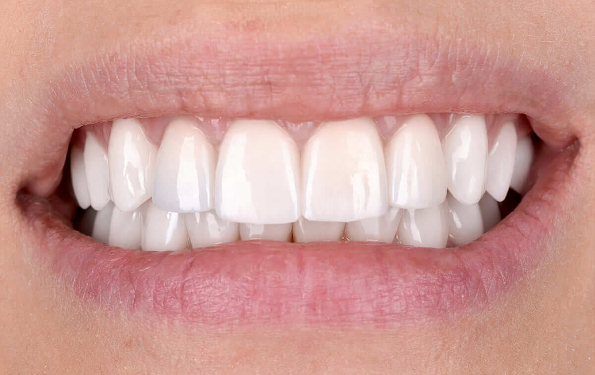 Prosthetics by ceramic crowns with high smile line