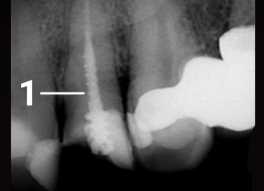 Пациент 50 лет после травмы обратился в клинику с жалобами на скол коронковой части зуба на верхней челюсти. Зуб ранее лечен в другом лечебном учреждении. После проведенного обследования выявлено необходимость перелечивания корневого канала. 1 – металлический штифт в канале зуба