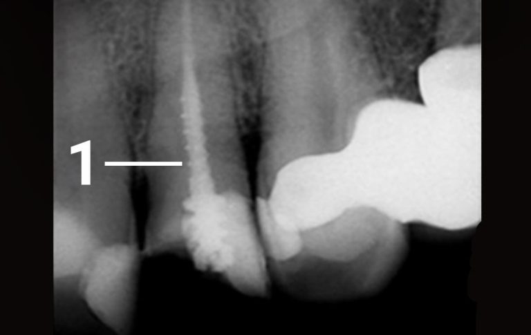 Пацієнт, 50 років, після травми звернувся в клініку зі скаргами на скол коронкової частини зуба на верхній щелепі. Зуб раніше лікували в іншому лікувальному закладі. Після проведеного обстеження виявлена необхідність перелікування кореневого каналу. 1 – металевий штифт в каналі зуба