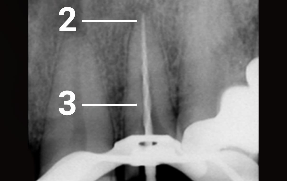 The endodontic treatment was performed under anaesthesia. The root canal was unsealed and checked with a follow up X-ray photo. 

2 – destruction of the bone tissue due to an incomplete treatment of the root canal 

3 – a tool used to monitor the complete passage through a root canal