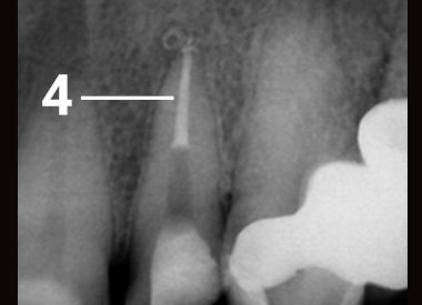 Законченное эндодонтическое лечение. Зуб подготовлен к дальнейшему протезированию. 4 – канал запломбирован