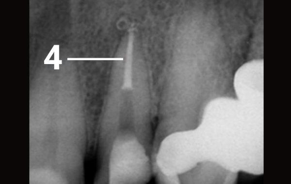 Carrying out endodontic treatment