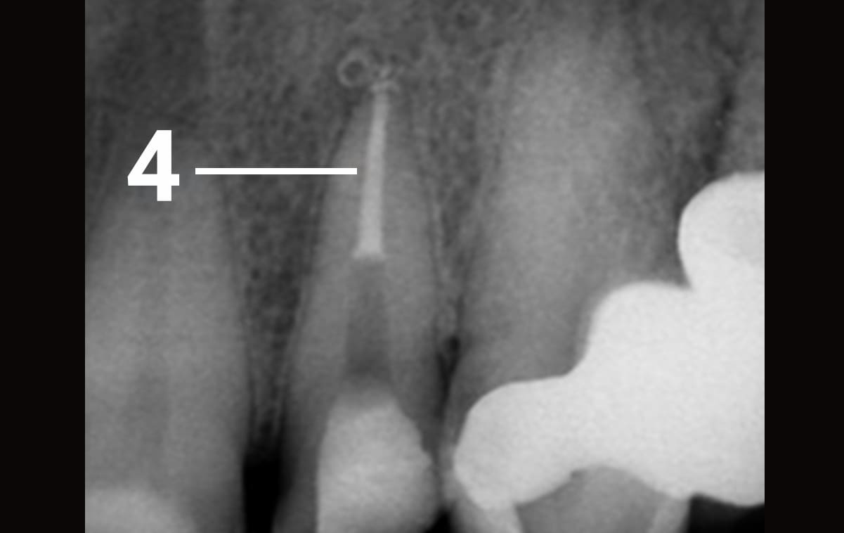 Endodontic treatment completed. The tooth is prepared for further prosthetics.

4 – the root canal is sealed