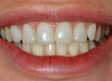 One of the new patients contacted the clinic with concerns regarding the change in the colour of old photopolymer restorations located in the anterior maxilla. The patient was unhappy with the shape of the teeth and how her smile appeared in photos. The patient wanted to have beautiful, white teeth. On the color scale, she...