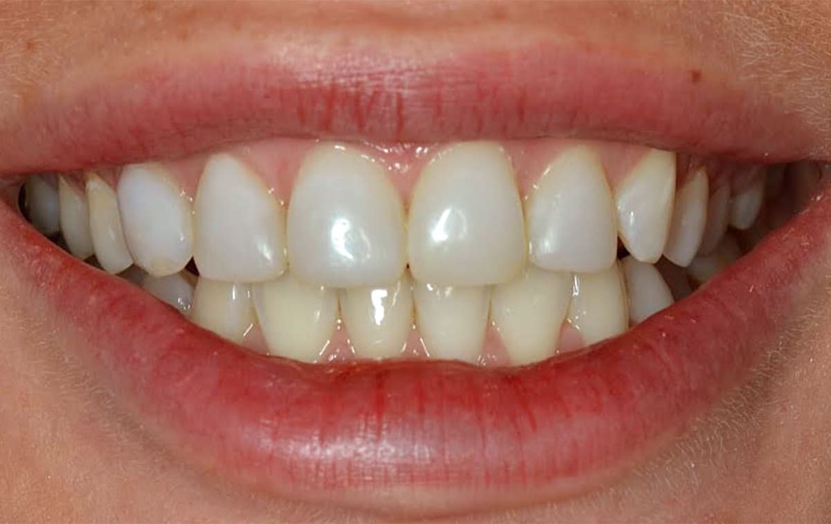 Пациентка обратилась с жалобами на изменение в цвете старых фотополимерных реставраций во фронтальном участке верхней челюсти. Ее не устраивала форма зубов и как выглядит ее улыбка на фото. 
Желанием пациентки было иметь красивые, белые зубы. По цветовой шкале она выбрала самые белые зубы. После моделирования новой формы зубов в компьютерной программе DSD (Digital Smile Desing) и мы приступили к созданию "новой улыбки".